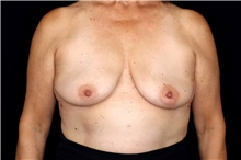Breast Implant Removal After Photo by Landon Pryor, MD, FACS; Rockford, IL - Case 47557