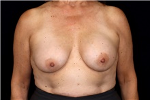 Breast Implant Removal Before Photo by Landon Pryor, MD, FACS; Rockford, IL - Case 47557