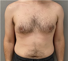 Male Breast Reduction Before Photo by Keshav Magge, MD; Bethesda, MD - Case 47599