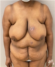 Mommy Makeover Before Photo by Keshav Magge, MD; Bethesda, MD - Case 47614