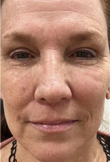 Lip Augmentation/Enhancement After Photo by Franklin Richards, MD; Bethesda, MD - Case 47634