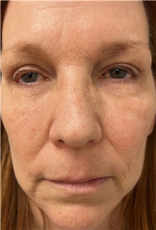 Lip Augmentation/Enhancement Before Photo by Franklin Richards, MD; Bethesda, MD - Case 47634