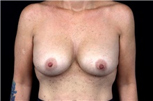 Breast Implant Removal Before Photo by Landon Pryor, MD, FACS; Rockford, IL - Case 47706