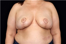 Breast Implant Removal After Photo by Landon Pryor, MD, FACS; Rockford, IL - Case 47710