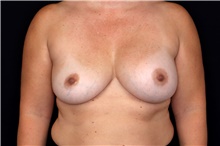 Breast Implant Removal Before Photo by Landon Pryor, MD, FACS; Rockford, IL - Case 47721