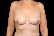 Breast Implant Removal After Photo by Landon Pryor, MD, FACS; Rockford, IL - Case 47724