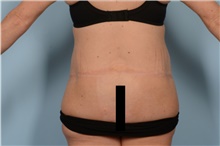 Body Lift After Photo by Ellen Janetzke, MD; Bloomfield Hills, MI - Case 47968
