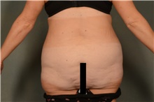 Body Lift Before Photo by Ellen Janetzke, MD; Bloomfield Hills, MI - Case 47968