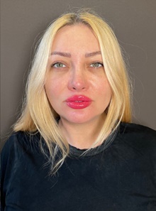 Rhinoplasty After Photo by Mark Albert, MD; New York, NY - Case 48002