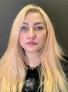 Rhinoplasty Before Photo by Mark Albert, MD; New York, NY - Case 48002