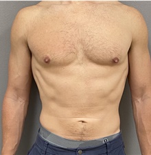 Male Breast Reduction After Photo by Keshav Magge, MD; Bethesda, MD - Case 48016