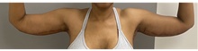Arm Lift After Photo by Keshav Magge, MD; Bethesda, MD - Case 48411