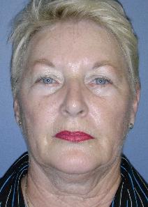 Dermal Fillers After Photo by James Lowe, MD; Oklahoma City, OK - Case 6769