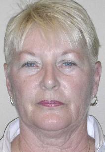 Dermal Fillers Before Photo by James Lowe, MD; Oklahoma City, OK - Case 6769