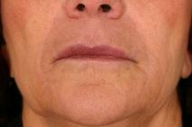 Dermal Fillers After Photo by Kent Hasen, MD; Naples, FL - Case 6853