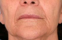 Dermal Fillers Before Photo by Kent Hasen, MD; Naples, FL - Case 6853