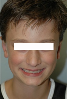 Ear Surgery After Photo by Susan Kaweski, MD; La Mesa, CA - Case 7999