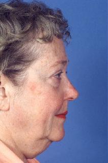 Facelift Before Photo by Bahman Guyuron, MD; Cleveland, OH - Case 8386