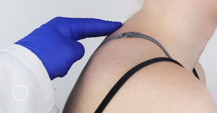 what is a buffalo hump and how is it removed?